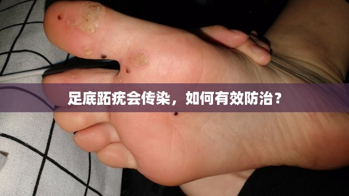 足底跖疣会传染,如何有效防治?